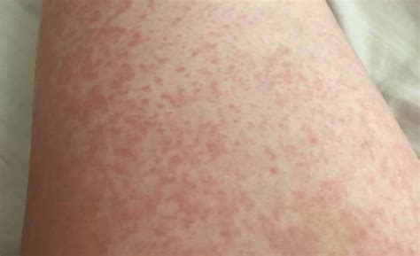 It is a life-threatening medical emergency. . Is sepsis rash itchy